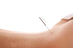 Closeup acupunture